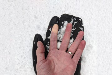 A person's hand showing signs of Raynaud's